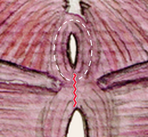 Third degree tear: reaches the anal sphincter, which is circled