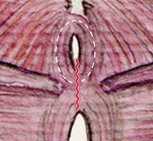 Fourth degree tear: extends through the anal sphincter to the anus